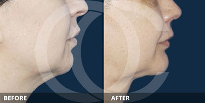 Chin Augmentation Implants | Ocean Clinic Marbella