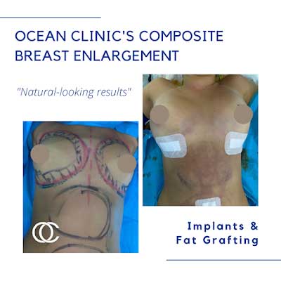 How is composite breast augmentation performed?