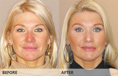 Blefaroplastia superior, eliminar las bolsas - Antes y después | Marbella Ocean Clinic