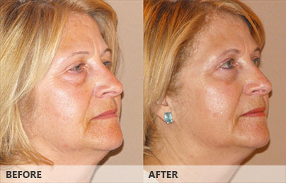 Blefaroplastia superiores - Antes y después | Marbella Ocean Clinic