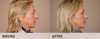 Operación párpados superior e inferior conjuntamente - Antes y después | Marbella Ocean Clinic