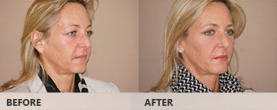 Blefaroplastia superior e inferior - Antes y después | Marbella Ocean Clinic