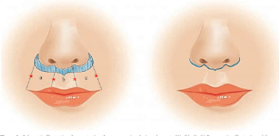  plastic surgery trends