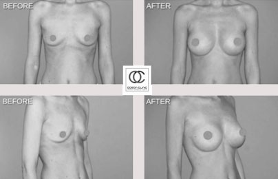 BREAST REVISIONS cosmetic procedure 2022 - Marbella | Ocean Clinic