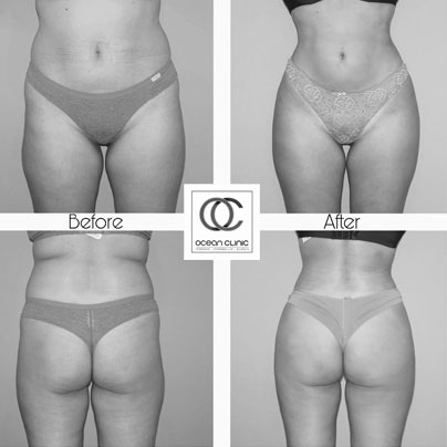 BODY CONTOURING cosmetic procedure 2022 - Marbella | Ocean Clinic