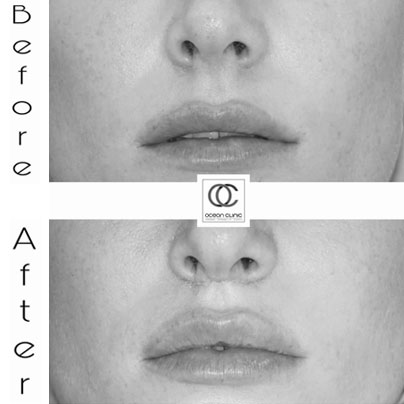 LIPS cosmetic procedure 2022 - Marbella | Ocean Clinic