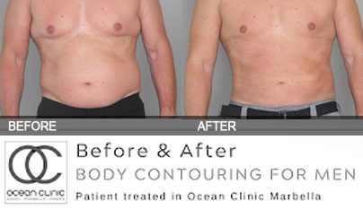 Daddy Do-Over Liposuction | Male Plastic Surgery Marbella Madrid