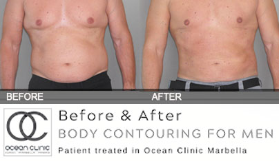 Daddy Do-Over Liposuction | Male Plastic Surgery Marbella