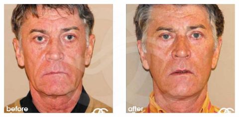 Daddy Do-Over Micro fat transfer | Male Plastic Surgery Marbella