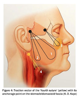 Verbesserung der Narbenbildung bei Facelift-Operation