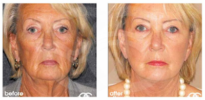 Facelift-Chirurgie: Ihre Fragen beantwortet