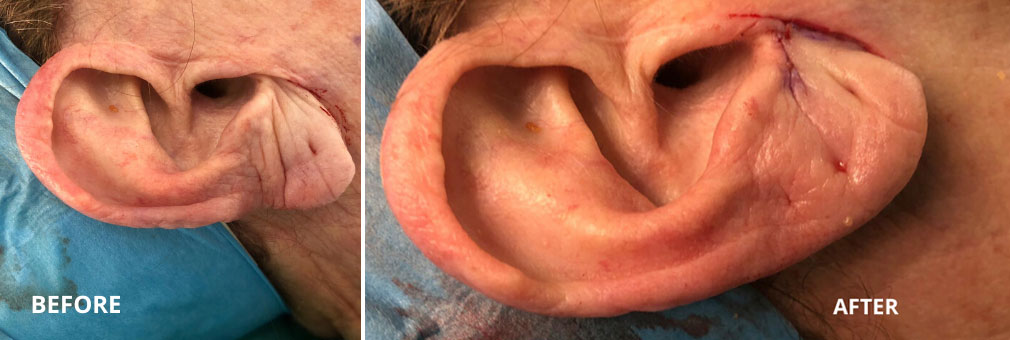 Earlobe Rejuvenation Surgery for Ageing Ears