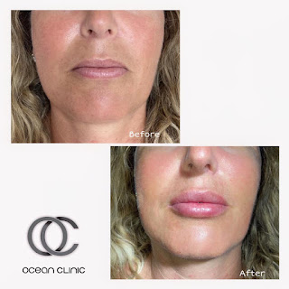 Relleno de labios - Marbella | Ocean Clinic