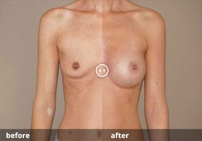 Foto antes y después aumento de pecho híbrido | Marbella Ocean Clinic