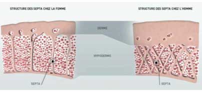 ¿Qué causa la celulitis?