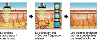 Cavitación ultrasonido