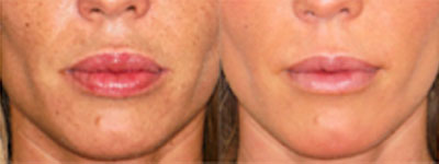 Labios rellenos permanentes Marbella Ocean Clinic