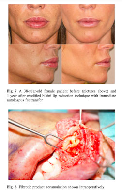 Arreglando los relleno permanente de labios