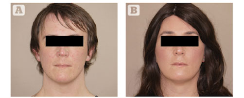 Figura 4 (A) Transgénero panfacial antes, y (B) después. Micrograsa frente 7 cc, barbilla 4 cc total, mandibular 10 cc, labios superiores/inferiores 2 cc cada uno, filtrum/supraoral 4 cc, malar 8 cc, infraorbital 3 cc, cejas lat 4 cc, sienes 8 cc por lado. Marbella Ocean Clinic