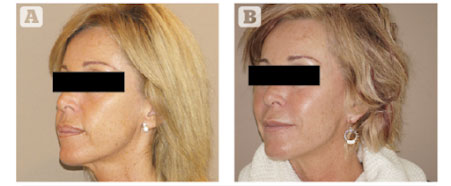 Figura 5 (A) mejilla/malar antes, y (B) después. Micrograsa frente 10 cc, mandibular 5 cc, barbilla 4 cc, labios superiores/inferiores 2 cc cada uno, filtro/supraoral 4 cc, malar 6 cc, infraorbital 3 cc, frente lateral 2 cc, sienes 8 cc por lado. Marbella Ocean Clinic