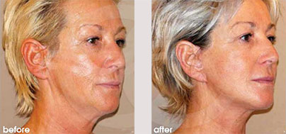 Estiramiento Facial Ligero 03 | Marbella Ocean Clinic