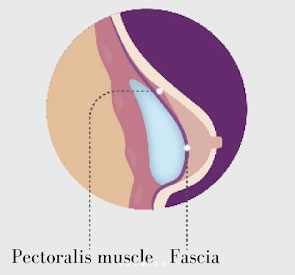 Dual plane - Colocación de implantes mamarios | Marbella Ocean Clinic