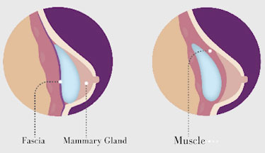 Submuscular, Subglandular - Colocación de implantes mamario submuscular | Marbella Ocean Clinic