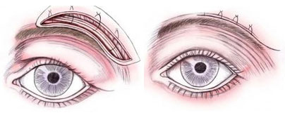 Lifting de cejas: Quirúrgico vs No Quirúrgico