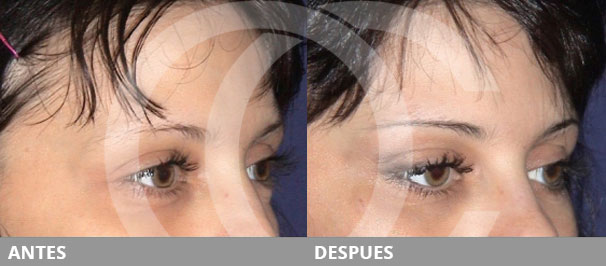 Quimiodenervación o lifting de cejas