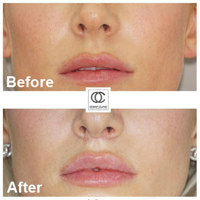 ¿Cuáles son los resultados del lifting de labios superior? Antes y después | Ocean Clinic Marbella