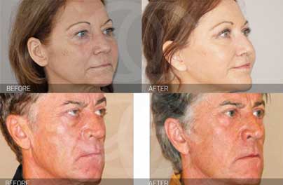 ¿Qué hace diferente al lifting facial PAVE de otros procedimientos?