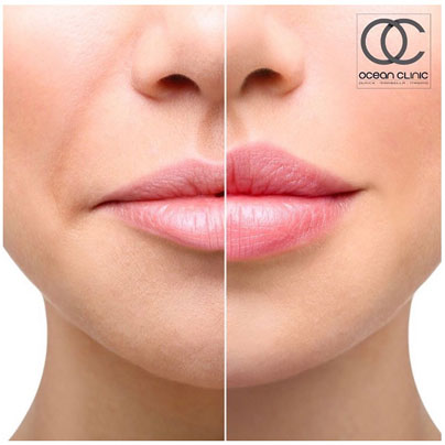 ¿Cuáles son los resultados del lip flip? | Ocean Clinic Marbella