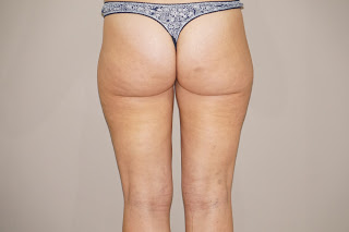 Liposucción para trata lipedema después p02