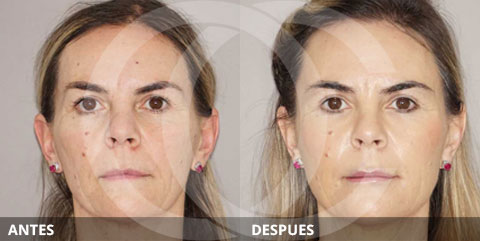 Antiaging: Lo mejor para restaurar el volumen: transferencia de grasa o rellenos