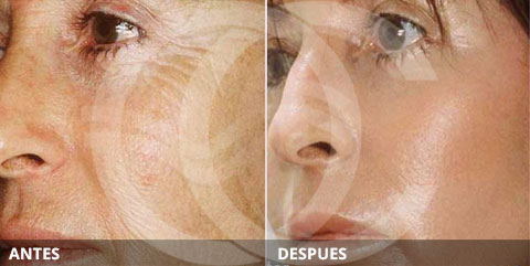 Antiaging: Lo mejor para tratar el daño solar: Peeling químico