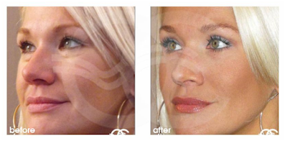 Blefaroplastia para rejuvenecer sus ojos Marbella Ocean Clinic