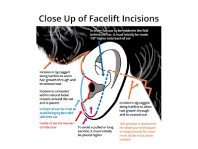 ¿Qué cicatrices tendré después de la cirugía de lifting facial?