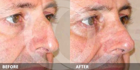 Fotos antes y después de Rinoplastia. Foto de Rinoplastia cerrada. Dar forma a la punta nasal, el puente, el dorso y el hueso nasal. Marbella Ocean Clinic