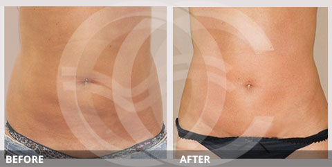 Fotos antes y después de abdominoplastia. Foto de miniabdominoplastia con lipoescultura. Marbella Madrid Ocean Clinic