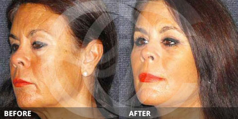 Foto de antes y después de Lifting de cara y cuello. Ritidectomia MACS. Marbella Ocean Clinic