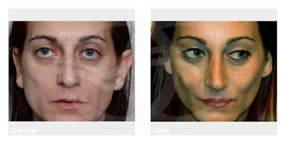 Rejuvenecimiento facial - Cara demacrada | Tratamientos estéticos avanzados