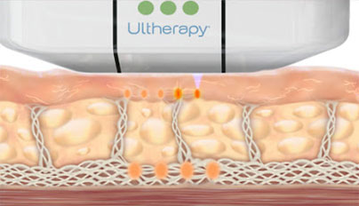 Ultherapy - espués del tratamiento, puede volver a sus actividades normales inmediatamente. Ocean Clinic Marbella