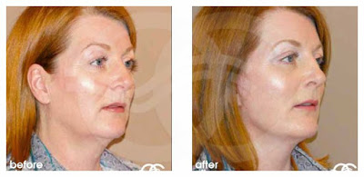 Why your forties can be a good time for a facelift