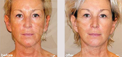 Facelift Lite - Lighter facelifts for 40-somethings | Marbella Ocean Clinic