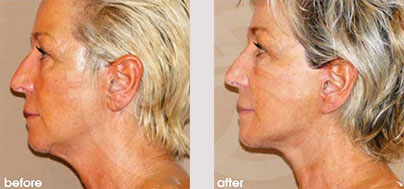 Facelift Lite - Lighter facelifts for 40-somethings | Marbella Ocean Clinic