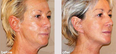 Facelift Lite - Lighter facelifts for 40-somethings | Marbella Ocean Clinic