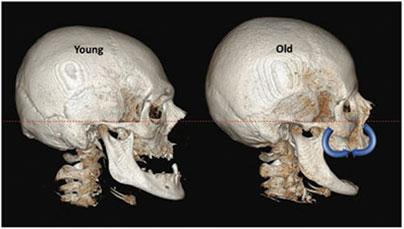 Skull and Facial Bone Changes with Age | Marbella Ocean Clinic