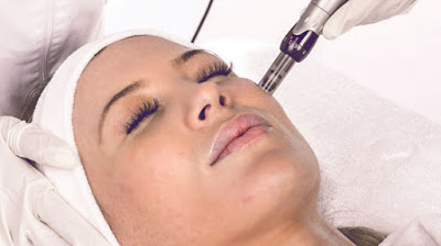 Nanofat microneedling as part of a “Fakelift”