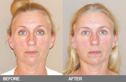 Botox as part of a “Fakelift”