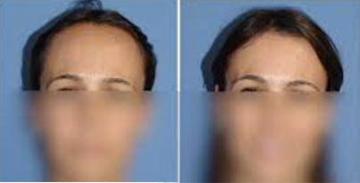 Steps of a forehead reduction procedure | Ocean Clinic Marbella